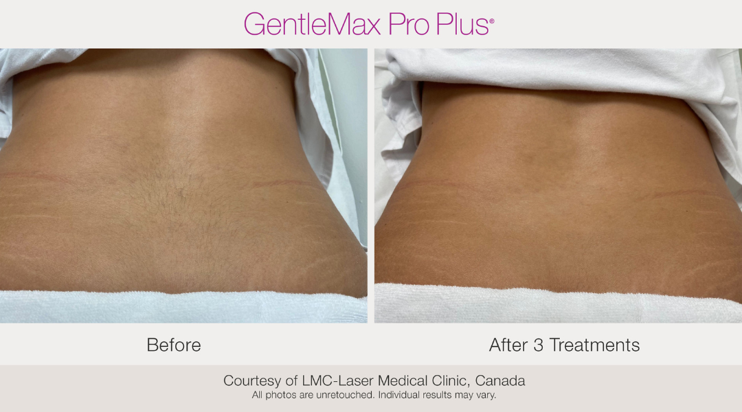 gentlemaxpro-beforeandafter3